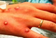 Photo of ИЈЗ: Лабораториски потврдени два случаи на мајмунски сипаници во нашата држава