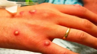 Photo of ИЈЗ: Лабораториски потврдени два случаи на мајмунски сипаници во нашата држава
