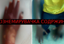 Photo of (Вознемирувачки фотографии) Support Kocani објави дел од изгореници на екстремитети кај младите за да надлежните сфатат колку се сериозни последиците