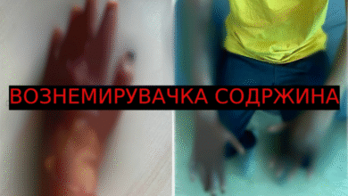 Photo of (Вознемирувачки фотографии) Support Kocani објави дел од изгореници на екстремитети кај младите за да надлежните сфатат колку се сериозни последиците