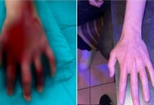 Photo of На повредените од пожарот во Кочани, на кои им е, или ќе им биде трансплантирана кожа, им се потребни силиконски гел листови