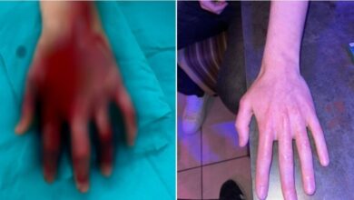 Photo of На повредените од пожарот во Кочани, на кои им е, или ќе им биде трансплантирана кожа, им се потребни силиконски гел листови