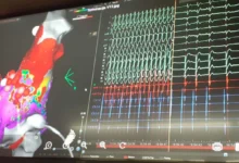 Photo of Воведена нова процедура на Кардиологија – пациентите со сложени срцеви аритмии веќе нема да бидат упатувани во странство