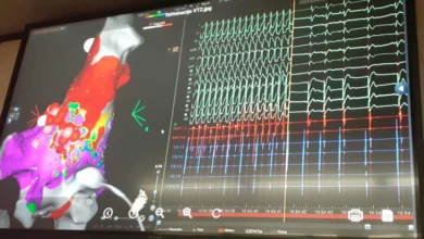 Photo of Воведена нова процедура на Кардиологија – пациентите со сложени срцеви аритмии веќе нема да бидат упатувани во странство