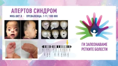 Photo of „Ги запознаваме ретките болести“: Апертов синдром